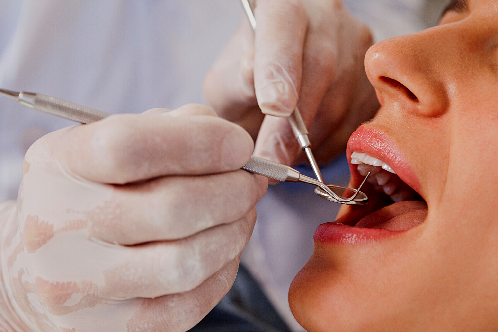 Cárie dentária: causas, tratamentos e prevenção